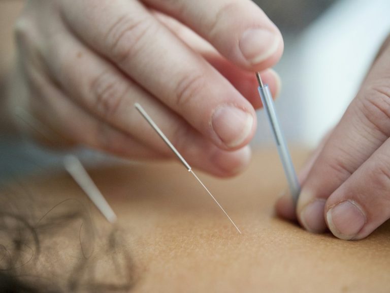 Stamford Spalding Acupuncture acupuncture needles